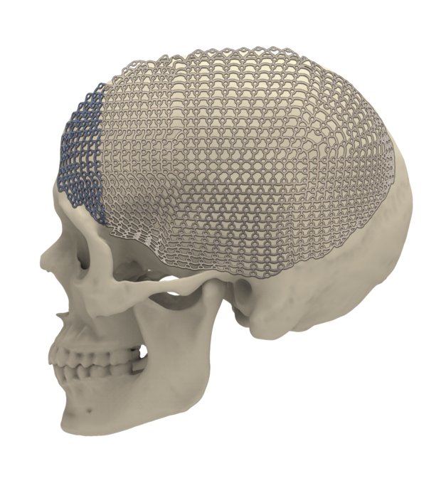 25-007-13-71 25-007-13-71  ~ MESH FRONTOTEMPOROPARIETAL LINKS XL STE ~