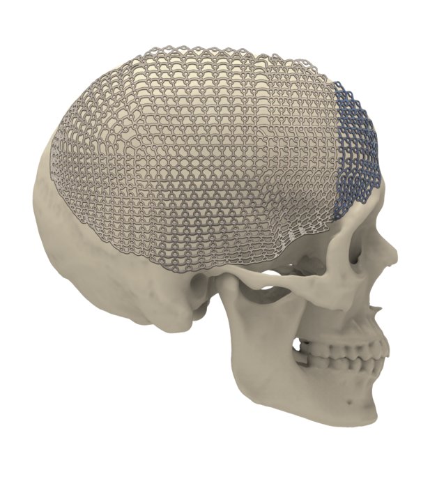 25-007-14-71 25-007-14-71  ~ MESH FRONTOTEMPOROPARIETAL RECHTS XL STE ~