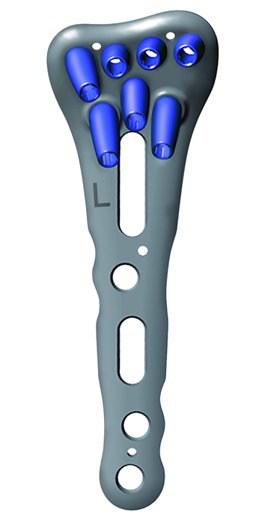 26-066-41-09 26-066-41-09  ~ RECOS RADIUS SIZER FÜR 26-166-41 ~