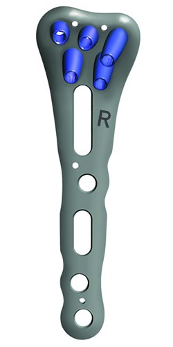 26-066-42-09 26-066-42-09  ~ RECOS RADIUS SIZER FÜR 26-166-42 ~