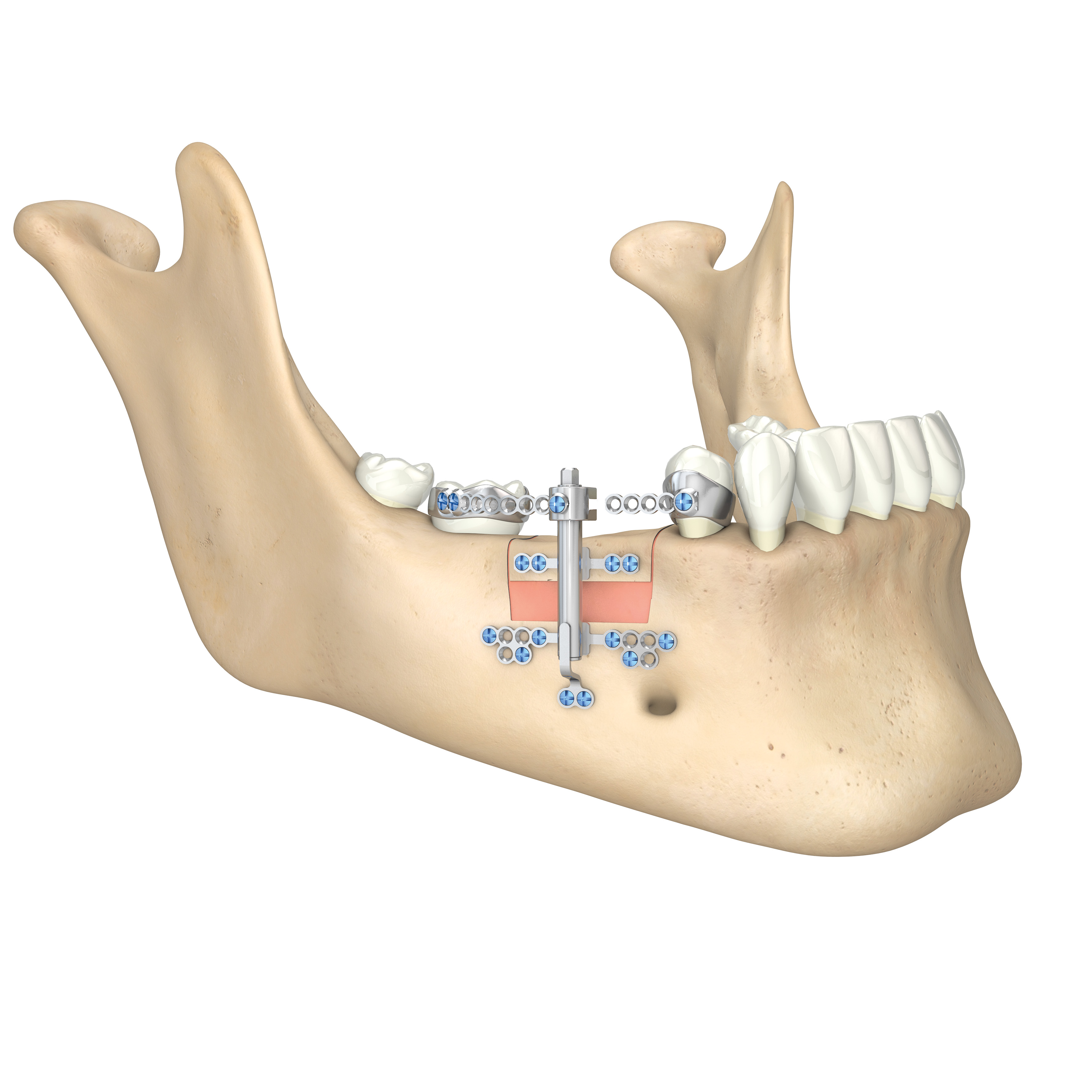 51-525-40-09 51-525-40-09  ~ ABSTUETZPLATTE FUER TRACK 1,0 MM ~
