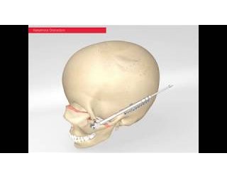 51-600-29-09 51-600-29-09  ~ Kontermutter für Molina Distraktor ~