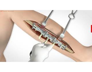 55-990-55-04 55-990-55-04  ~ L1 ReconGuide Implantatelagerung, kpl. ~