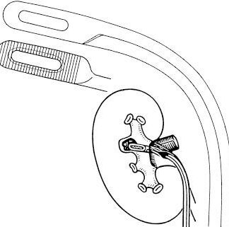 31-103-22-07  ~ NIERENSTEINZANGE, RANDALL, FIG. 2, 21 CM ~