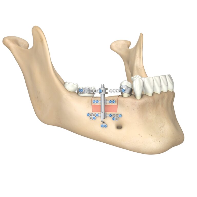 51-525-40-09 51-525-40-09  ~ ABSTUETZPLATTE FUER TRACK 1,0 MM ~